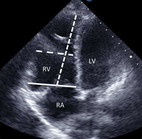 mildly dilated right ventricle treatment.